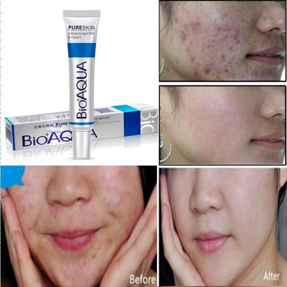 BIOAQUA 2 Pcs Anti Acne Scar Mark Remover Acne Scar Removal Cream - Image 4