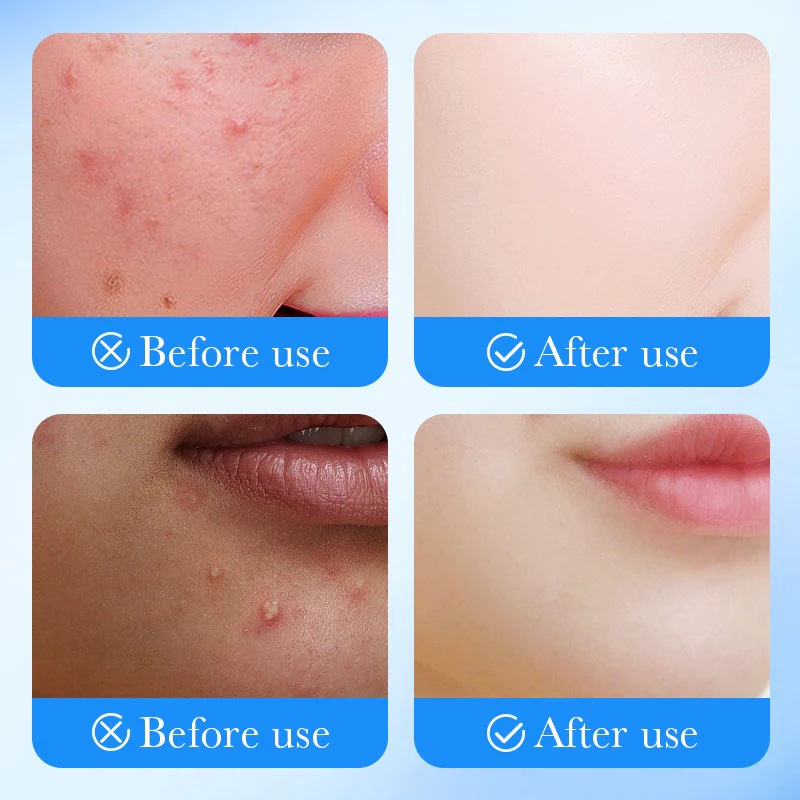 SADOER Acne Patch - Hydrocolloid & Star+Round - Invisible Protection - Image 4