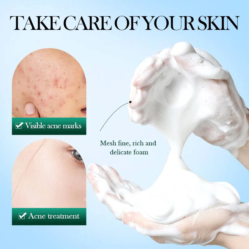 SADOER Tea Tree Acne Clean Mousse - Oil Control Foam Cleanser - 150g - Image 5